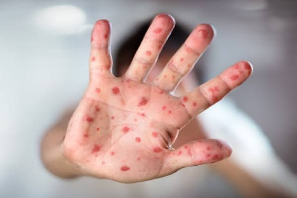 Kasus Campak di Riau Meningkat, Diskes Riau Tekankan Pentingnya Imunisasi